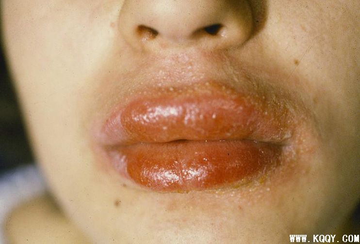 Contact Dermatitis Lips