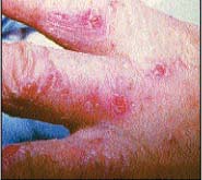 Contact Dermatitis On Hands