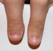 Megan Fox Thumb Deformity